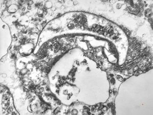 M,50y. | Pneumocystis carinii - lung